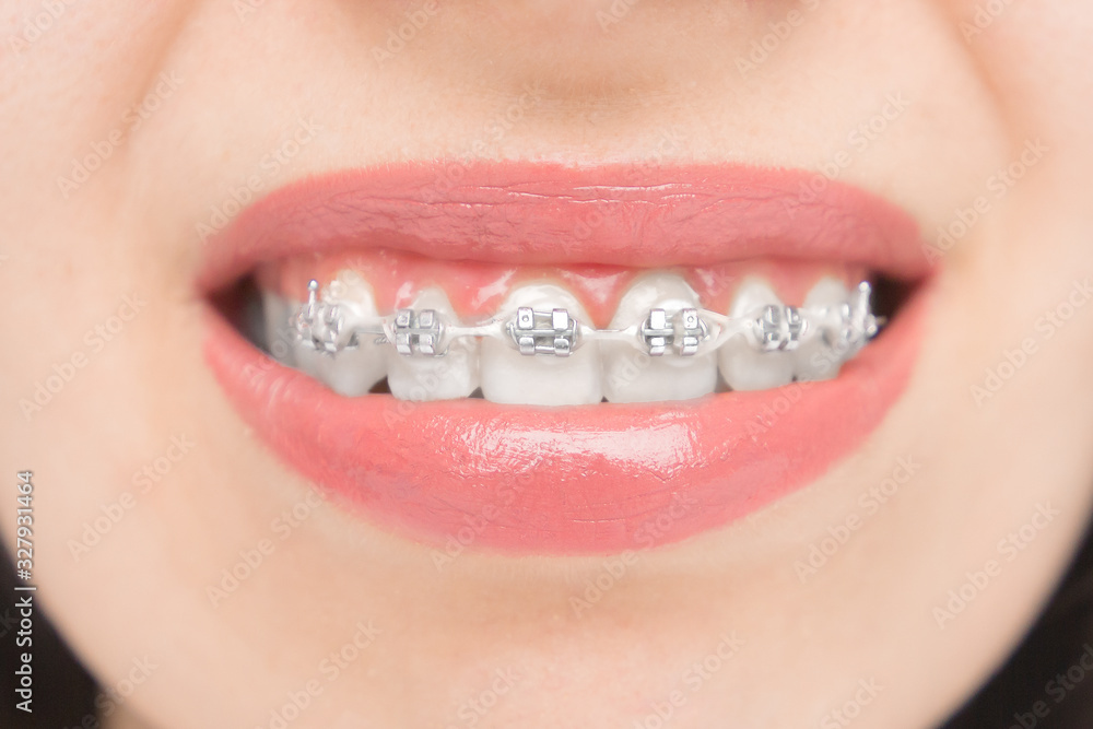 Close up to dental braces. Brackets on the teeth after whitening.  Self-ligating brackets with metal ties and gray elastics or rubber bands.  Orthodontic teeth treatment Stock Photo | Adobe Stock