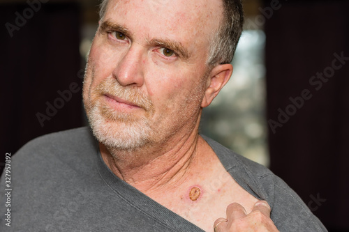 portrait of a man showing healing scar from skin cancer