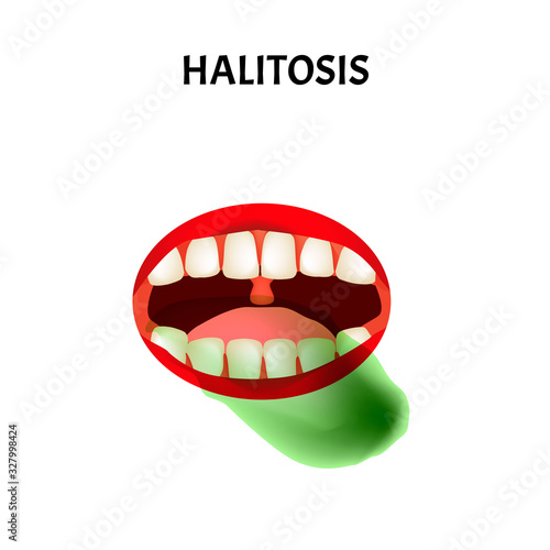 bad breath. Halitosis. The structure of the teeth and oral cavity. Diseases of the teeth. Infographics. Vector illustration on isolated background.