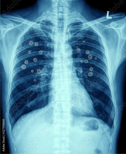 Novel Covid-19, Wuhan virus concept , Chest x-ray Coronavirus of lungs radiology