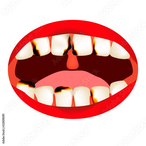 caries. Smell from the mouth. Halitosis. The structure of the teeth and oral cavity. Diseases of the teeth caries. Infographics. Vector illustration on isolated background.