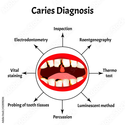 Diagnosis of caries. Bad breath. Halitosis. The structure of the teeth and oral cavity with caries. Diseases of the teeth. Infographics. Vector illustration on isolated background.