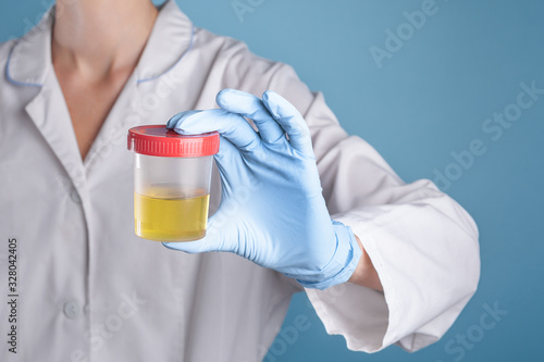 Doctor in white uniform and blue medical gloves holding a container for urine analysis. Urine testing for diseases and drugs in clinic