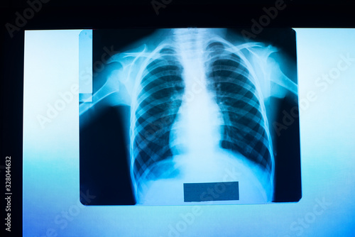 x-ray image of the lungs, the picture is hanging on a medical negatoscope