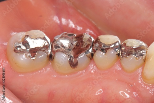 銀歯 歯科治療