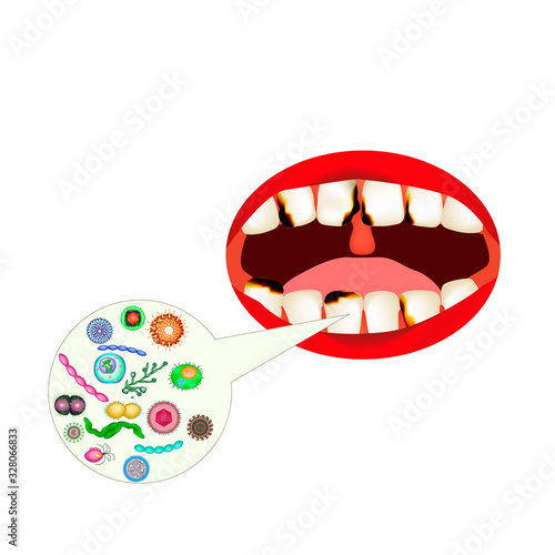 caries. Smell from the mouth. Halitosis. The structure of the teeth and oral cavity. Diseases of the teeth caries. Infographics. Vector illustration on isolated background.