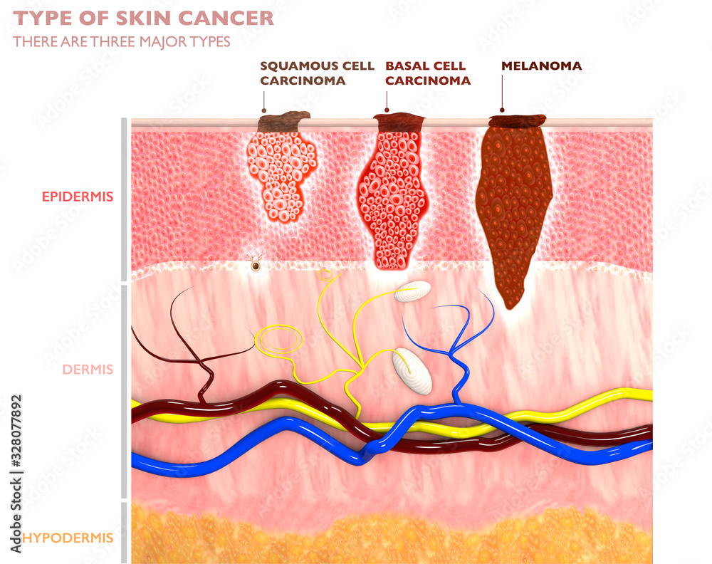 Skin tumors, moles and spots, 3d section of the skin layer. Three types of skin  cancer, squamous cell carcinoma, basal cell carcinoma, melanoma. 3d render  Stock Illustration | Adobe Stock