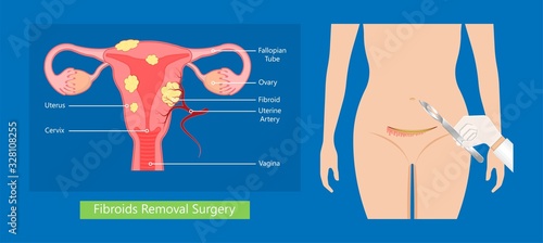 laparoscopic hysterectomy medical surgical treat cervix ovary subtotal minimally invasive procedure MIP Open UFE tumor agents diagnosis UAE guided Focused Ultrasound ovarian pcos pmdd cysts