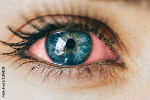 фотографія sick red eye conjunctivitis, tired eye, working at the computer