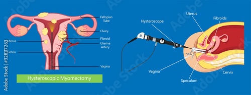 laparoscopic hysterectomy medical surgical treat cervix ovary subtotal minimally invasive procedure MIP Open UFE tumor agents diagnosis UAE guided Focused Ultrasound ovarian pcos pmdd cysts