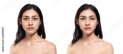 Cosmetology concept. Beauty young asian woman has freckles, blemish, acne, dull skin compare another side beautiful woman has clear and nice skin face, body after get treatment of cosmetology spa