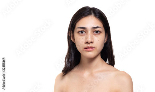 Beautiful asian woman get freckles, blemish, pimple or acne, dull skin, scar on beauty face. Charming beautiful young woman get problems of her skin. She looks unhappy. isolated on white, copy space