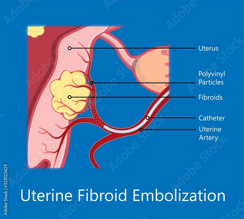 laparoscopic hysterectomy medical surgical treat cervix ovary subtotal minimally invasive procedure MIP Open UFE tumor agents diagnosis UAE guided Focused Ultrasound ovarian pcos pmdd cysts photo