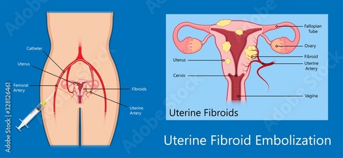 laparoscopic hysterectomy medical surgical treat cervix ovary subtotal minimally invasive procedure MIP Open UFE tumor agents diagnosis UAE guided Focused Ultrasound ovarian pcos pmdd cysts