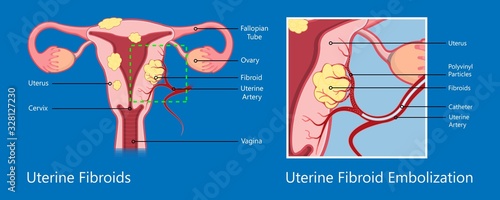 laparoscopic hysterectomy medical surgical treat cervix ovary subtotal minimally invasive procedure MIP Open UFE tumor agents diagnosis UAE guided Focused Ultrasound ovarian pcos pmdd cysts photo