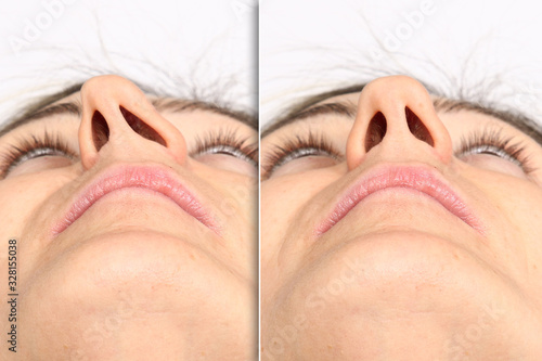 Collage comparing situation before and after rhinoplasty correcting deviated nasal septum. Caucasian woman and performed medical procedure. Medicine and healthcare concept.