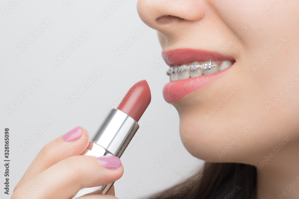 Naklejka premium Red lipstick and teeth with dental braces. Brackets on the teeth after whitening. Self-ligating brackets with metal ties and gray elastics or rubber bands for perfect smile