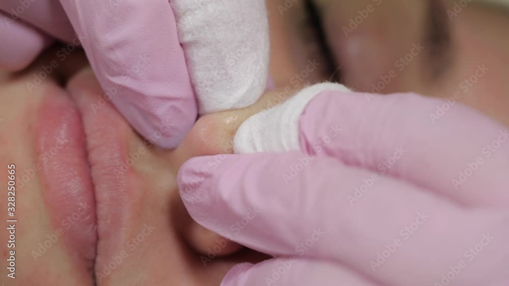 Cleansing the skin of the nose from black spots. Cleansing the skin of the nose from black spots.