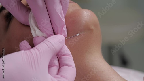 The procedure of lifting the face using special threads.