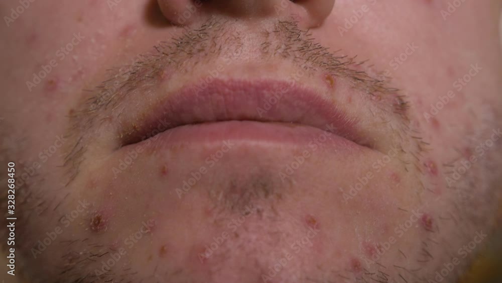 Red Man Rash Itching on the skin for chickenpox in an adult male. Many red rashes ...