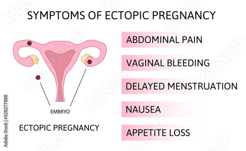 Symptoms of ectopic pregnancy. Infographics. illustration on isolated background. The fertilized egg, uterus, womb.