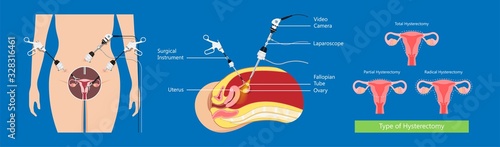 laparoscopic hysterectomy medical surgical treat cervix ovary subtotal minimally invasive procedure MIP Open UFE tumor agents diagnosis UAE guided Focused Ultrasound ovarian pcos pmdd cysts	