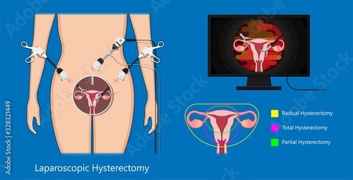 laparoscopic hysterectomy medical surgical treat cervix ovary subtotal minimally invasive procedure MIP Open UFE tumor agents diagnosis UAE guided Focused Ultrasound ovarian pcos pmdd cysts	