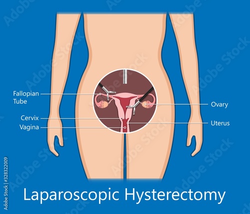 laparoscopic hysterectomy medical surgical treat cervix ovary subtotal minimally invasive procedure MIP Open UFE tumor agents diagnosis UAE guided Focused Ultrasound ovarian pcos pmdd cysts	