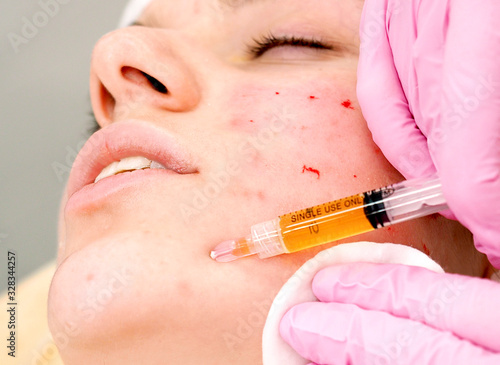 plasmolifting injection procedure. plasma injection into the skin of the patient's cheeks