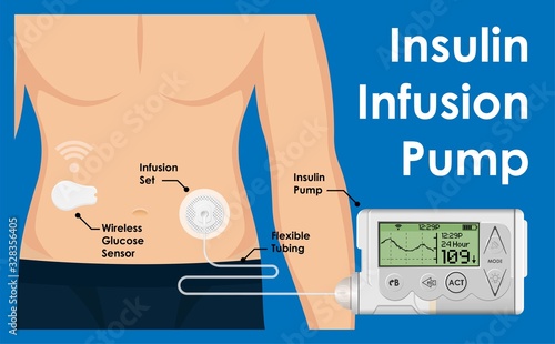 Insulin Infusion Pump on Patient Body Electronic Medical Digital Technology Device Therapy Diabetes Sugar Blood Automatic Control by Programming and Monitoring Glucose with Bio Sensor photo