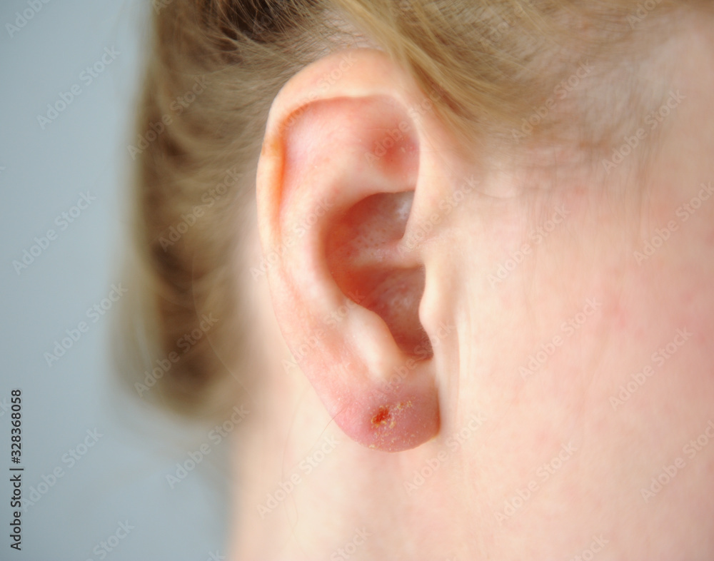 Atopic dermatitis (AD), also known as atopic eczema, is a type of skin