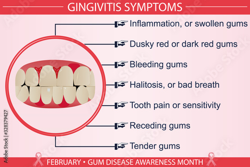 Gingivitis disease symptoms infographic vector illustration. Health, healthcare, and february gum disease awareness month concept. For presentation, brochure, banner, websites. Eps 10 file format.