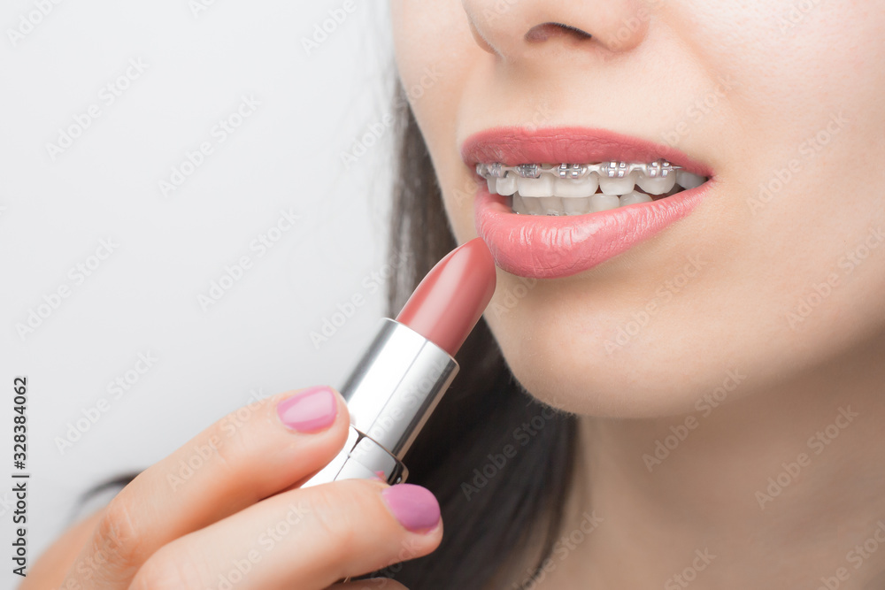 Red lipstick and teeth with dental braces. Brackets on the teeth after whitening. Self-ligating brackets with metal ties and gray elastics or rubber bands for perfect smile
