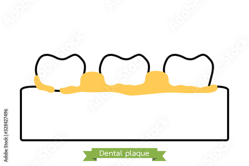 dental plaque or tartar, cause of tooth periodontal disease - teeth cartoon vector outline flat style