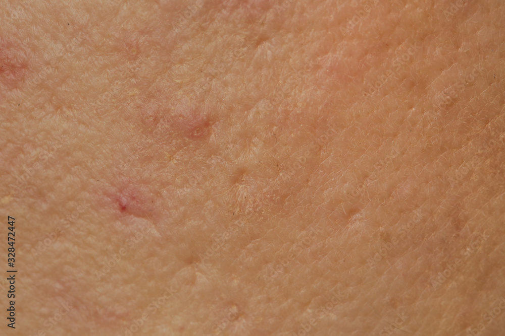 Fototapeta premium Close up of female face problematic sensitive skin with large pores, redness and acne