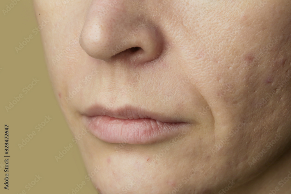 Close up of female face problematic sensitive skin with large pores, redness and acne Close up of female face problematic sensitive skin with large pores, redness and acne