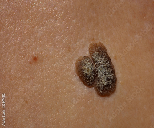 Seborrheic Keratosis, skin problem occurring to a Caucasian.  A close up shows cracks of mole, brown and patchy.  It is most common noncancerous skin growths in older adults. Not contagious photo