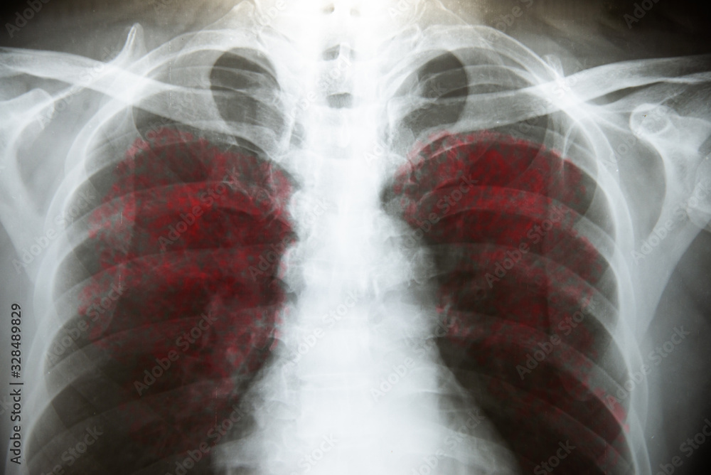 Chest X-Ray on pateint coronavirus or covid-19. Chest X-Ray on pateint coronavirus or covid-19.