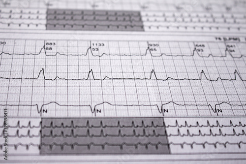 Heartbeat represented on paper. Cardiac arrhythmias. Selective focus on some beats. Atrial fibrillation Intraventricular conduction disorder Free space to write.