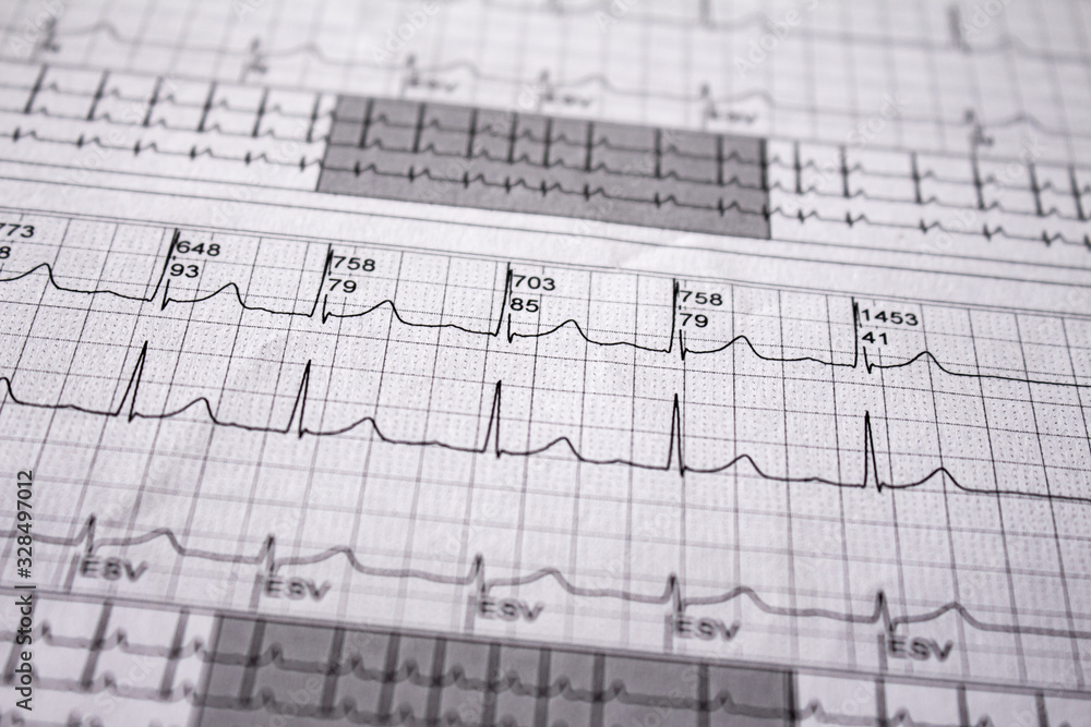 Heartbeat represented on paper. Cardiac arrhythmias. Selective focus on some beats. Free space to write. Heartbeat represented on paper. Cardiac arrhythmias. Selective focus on some beats. Free space to write.