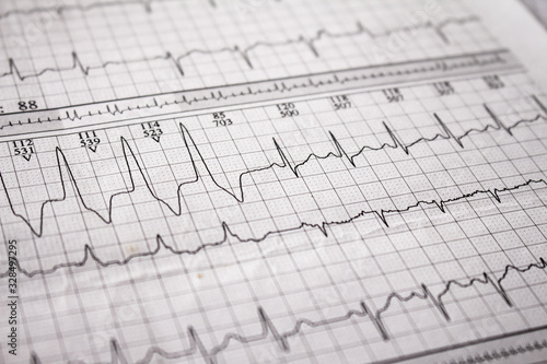 Heartbeat represented on paper. Cardiac arrhythmias. Selective focus on some beats. Free space to write.