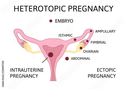 Heterotopic Pregnancy. extra-uterine ectopic pregnancy and intrauterine pregnancy occur simultaneously photo