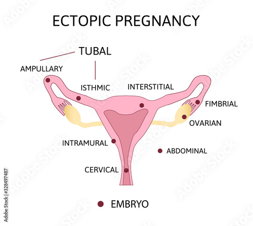 Ectopic Pregnancy. Types of Tubal pregnancy, ovarial, abdominal,