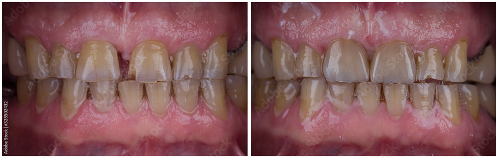 Obraz premium before and after picture of dental treatment by 2 unit press ceramic cowns