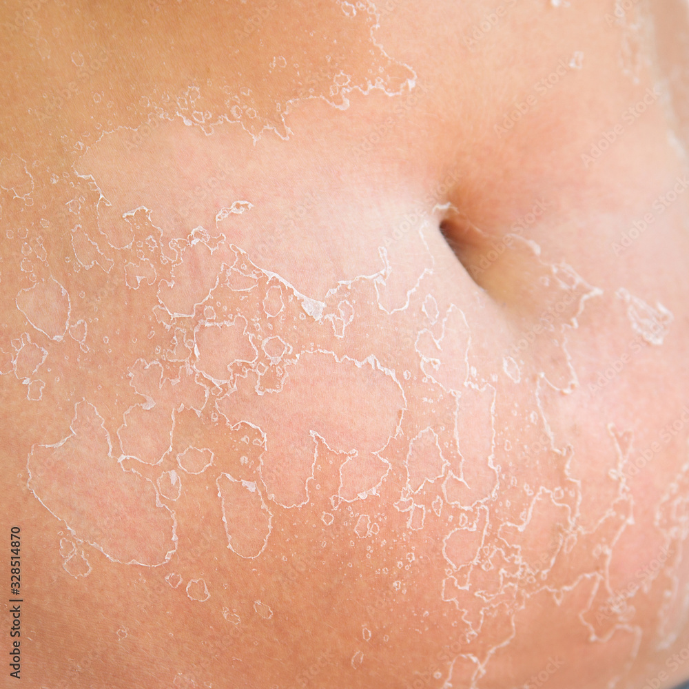 Fototapeta premium Sunburn on the female belly skin. Exfoliation, skin peels off.