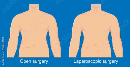appendectomy medical surgery organ colon tool heal room body doctor pain scars liver cancer tummy tumor mass trocars nurse pelvic video health system display urology monitor endoscopic cholecystitis