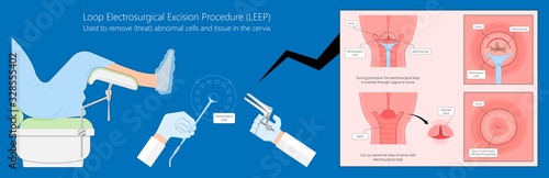 Cold knife cone biopsy Loop Electrosurgical Excision Procedure LEEP Large Loop Excision of the Transformation Zone LLETZ remove tissue from the cervix for precancerous cell laser diathermy per treat