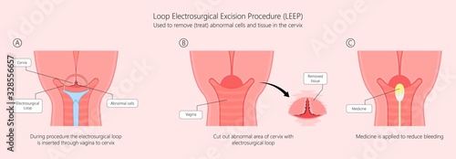 Cold knife cone biopsy Loop Electrosurgical Excision Procedure LEEP Large Loop Excision of the Transformation Zone LLETZ remove tissue from the cervix for precancerous cell laser diathermy per treat photo