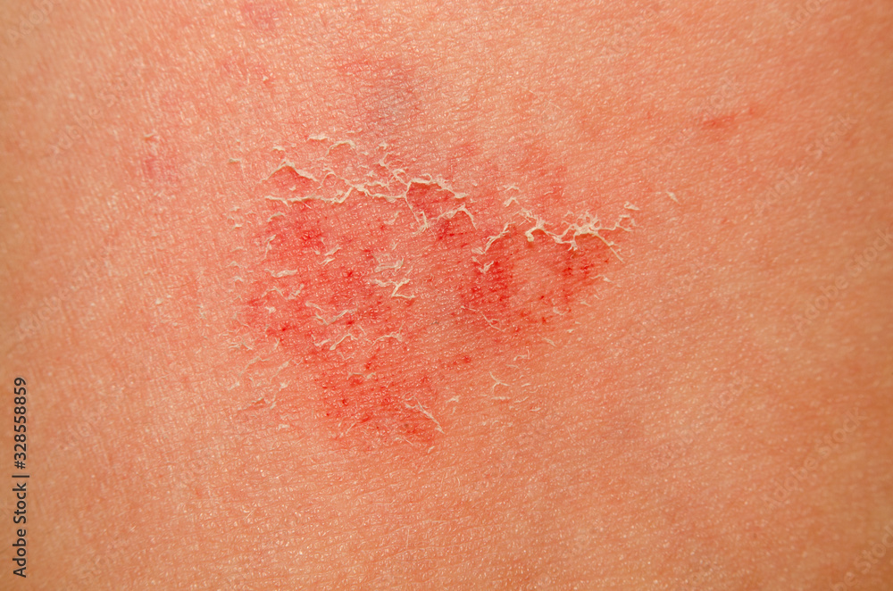 Fototapeta premium A large wound on the skin of a child close-up