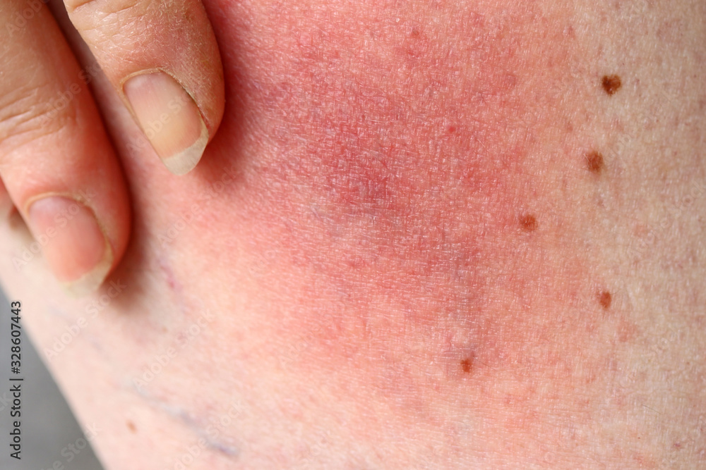 Wanderröte durch eine Zecke übertragene Lyme-Borreliose Erkrankung am Bein einer Frau. Hautrötung am Bein durch eine Allgerie Wanderröte durch eine Zecke übertragene Lyme-Borreliose Erkrankung am Bein einer Frau. Hautrötung am Bein durch eine Allgerie
